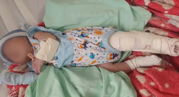 Criança passa bem, apesar da perna quebrada em maternidade da RMS — Foto: Reprodução/ Redes sociais