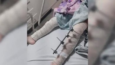 Médicos se confundem e operam perna errada de menina de 6 anos - Foto: Reprodução